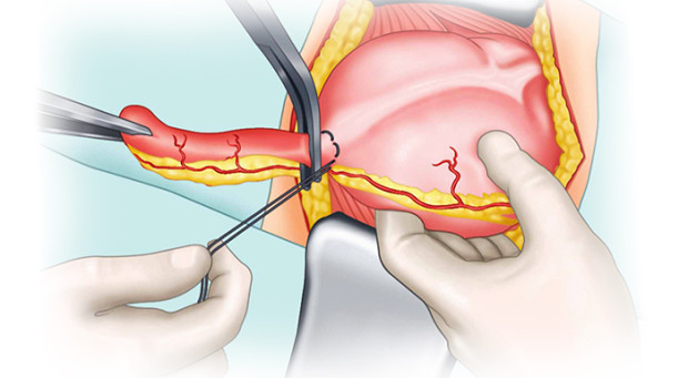 Cirurgia não-cardíaca, apendicectomia, laparectomia