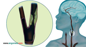 Imagem artéria carótida com placa aterosclerótica. Doença das artérias carótidas